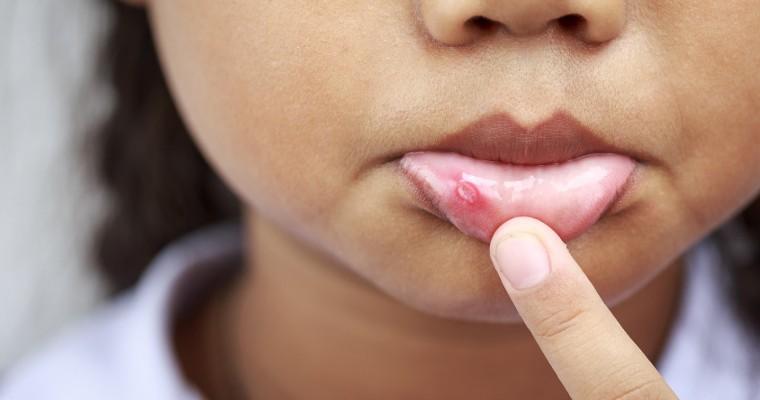 Dziecko delikatnie odchyla palcem usta i pokazuje aftę