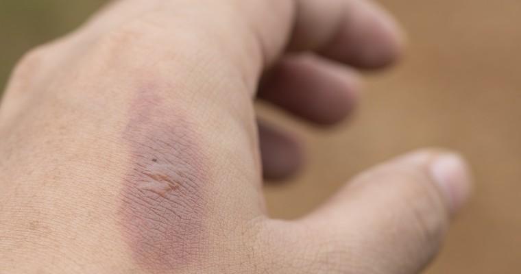dłoń po oparzeniu z blizną 