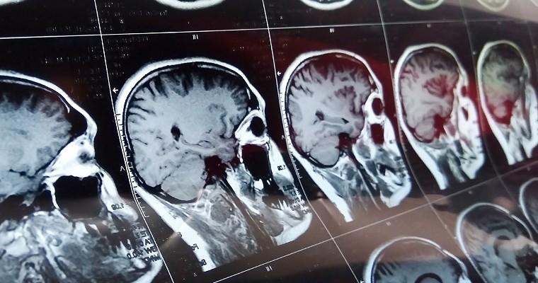  Skan rezonansu magnetycznego mózgu z czaszką
