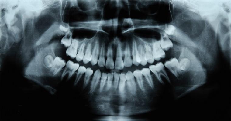 Zdjęcie rentgenowskie zębów.