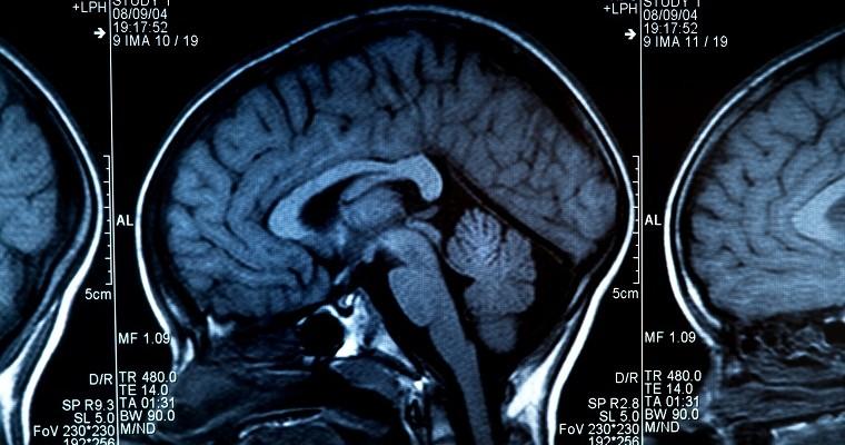Skan MRI ludzkiego mózgu i czaszki