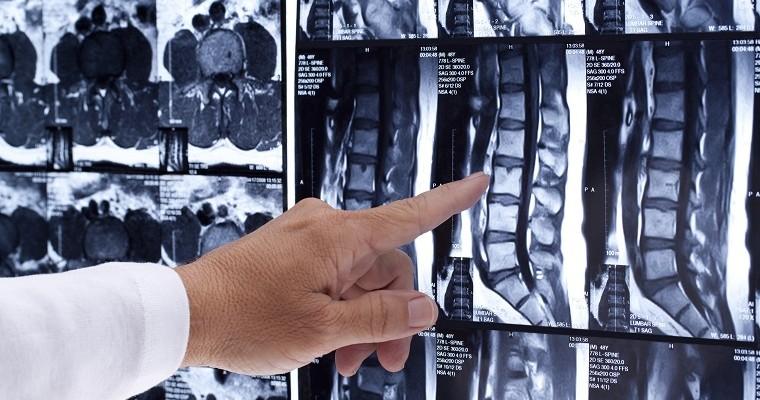 lekarz wskazuje palcem na rentgen ludzkiego kręgosłupa odcinka lędźwiowego 