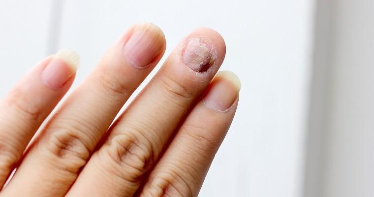 Zniszczony paznokieć z krwiakiem