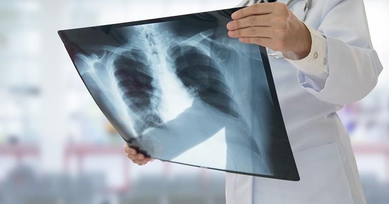 Lekarz, który ogląda zdjęcie rentgenowskie płuc 