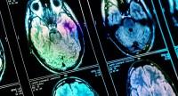 Jak objawia się rak mózgu?
Rozpoznanie i leczenie choroby