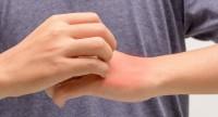 Swędzenie dłoni po zewnętrznej i wewnętrznej stronie – przyczyny i możliwe choroby