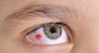Czerwona plamka na oku. Przyczyny i leczenie