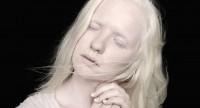 Jakie są objawy albinizmu i konsekwencje choroby?