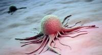 Rak naciekający – jakie są rodzaje, rokowania i metody leczenia nowotworów inwazyjnych?