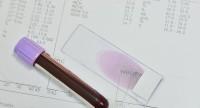 Badanie ASO – na czym polega, kiedy je wykonać i jakie są normy stężenia antystreptolizyny we krwi? 