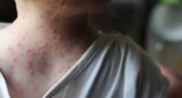 Choroby zakaźne skóry o podłożu bakteryjnym, wirusowym i grzybiczym