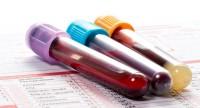 PSA – badanie z krwi:
na czym polega?
Normy, interpretacja wyników, cena