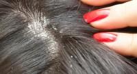 Łupież tłusty może powodować wypadanie włosów:
objawy, przyczyny, leczenie, domowe sposoby