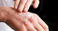 Egzema na dłoniach – leczenie domowe, przyczyny, czy jest zaraźliwa?