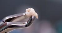 Ekstrakcja zęba – jak przebiega wyrywanie zęba, czy zabieg można wykonywać w ciąży?