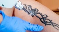 Laserowe usuwanie tatuażu - na czym polega, efekty, czy zabieg jest bolesny?