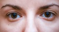 Podkrążone oczy i ich najczęstsze przyczyny.
Najlepsze sposoby na wory pod oczami