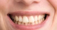 Żółte zęby – czego należy unikać, aby mieć biały uśmiech?