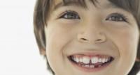 Krzywe zęby u dzieci i dorosłych – licówki i inne sposoby