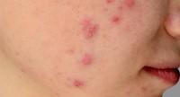 Choroby alergiczne skóry – rodzaje, objawy i przyczyny