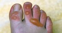 Pęcherze na stopach – czym są?
Jak je skutecznie leczyć?