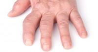 Choroba zwyrodnieniowa stawów kolanowych i rąk.
Objawy i metody leczenia 