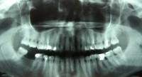Badanie RTG zębów - prześwietlenie w stomatologii
