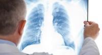 Czy rozedma płuc jest śmiertelna?
Jak rozpoznać objawy?