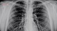 Rak płuc – jak skutecznie go leczyć?
Jakie mogą być pierwsze objawy choroby?
