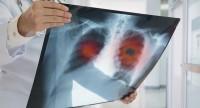 Ile się żyje z rakiem płuc?
Długość życia w zależności od typu raka