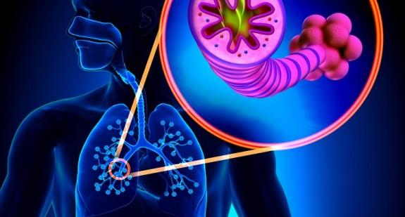 Przewlekła obturacyjna choroba płuc – objawy POCHP, leczenie i przyczyny choroby