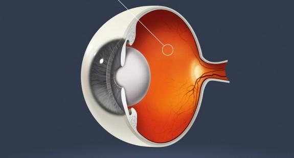 Czym jest retinopatia cukrzycowa? Objawy i leczenie retinopatii – powikłania cukrzycy