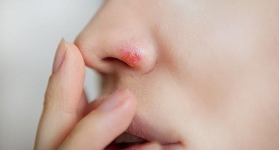 Jak się pozbyć opryszczki w nosie?