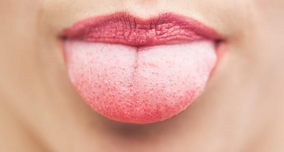 Pieczenie języka – przyczyny, objawy towarzyszące i leczenie