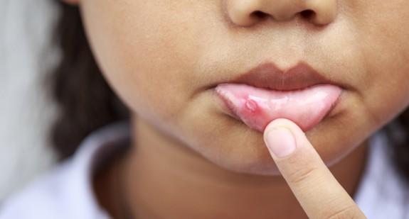 Domowe sposoby na afty w jamie ustnej. Leczenie dolegliwości u dzieci i dorosłych