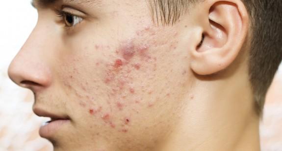 Najczęstsze choroby skóry twarzy – przyczyny, objawy, leczenie