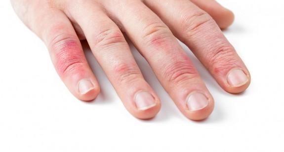 Wyprysk potnicowy (na dłoniach, stopach) – przyczyny, objawy, leczenie
