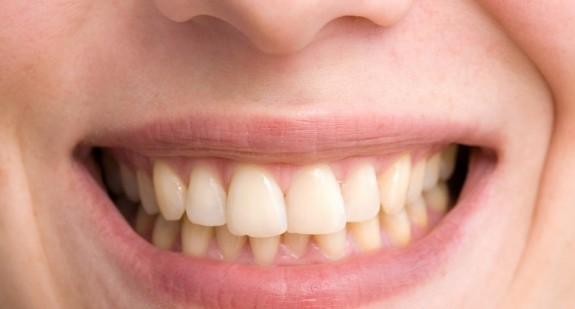 Żółte zęby – czego należy unikać, aby mieć biały uśmiech?