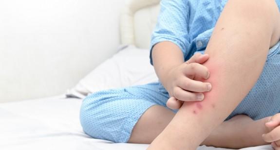 Wysypka na nogach u dziecka – kiedy należy się niepokoić na jej widok?