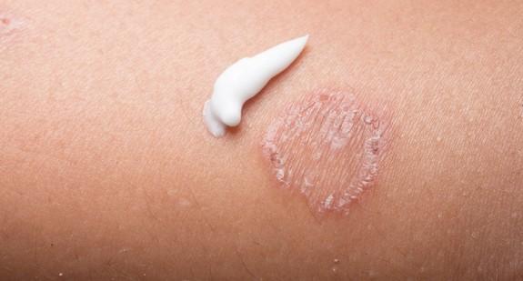 Grzybica skóry – jakie są objawy? Leczenie grzybicy skóry, domowe sposoby