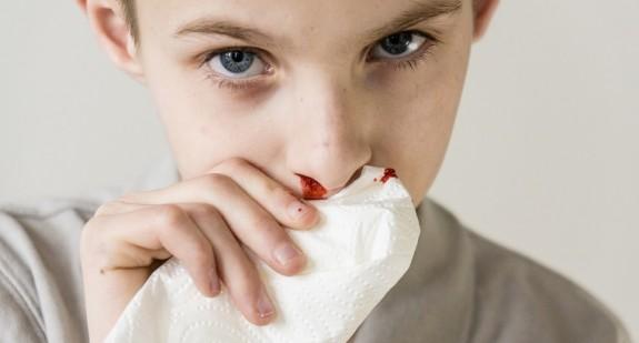 Krwotok z nosa – przyczyny i skuteczne sposoby tamowania krwawienia