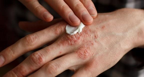 Atopowe zapalenie skóry – choroba alergiczna dzieci i niemowląt. Przyczyny, rozpoznanie i leczenie AZS. Wskazówki jak należy pielęgnować skórę dziecka z AZS
