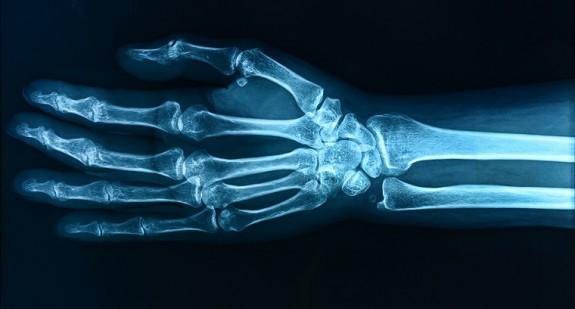 RTG nadgarstka – badanie kości, ocena wieku kostnego