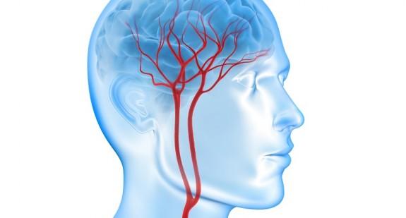 Wylew krwi do mózgu (udar krwotoczny): przyczyny, objawy, rozpoznanie, pierwsza pomoc, leczenie i rokowania