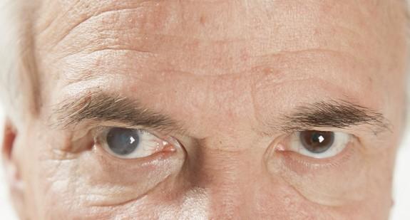 Bielmo na oku (zmętnienie rogówki) – przyczyny, objawy i leczenie