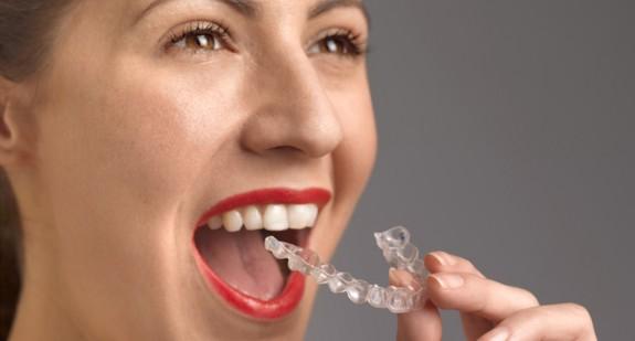 Aparat ortodontyczny na noc – wskazania, efekty i cena leczenia