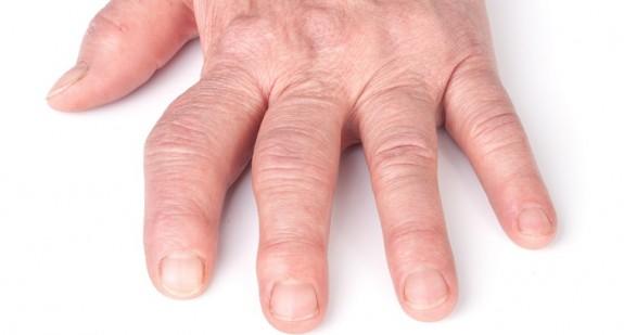 Choroba zwyrodnieniowa stawów kolanowych i rąk. Objawy i metody leczenia 