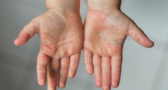 Czerwone plamy na rękach - jakie mogą być przyczyny?