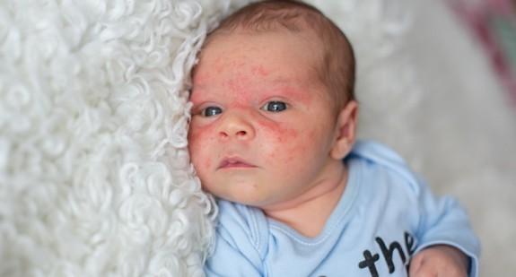 Kaszka na twarzy u dorosłych i niemowląt – przyczyny i leczenie