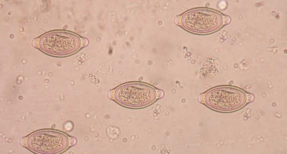 Schistosomatoza – najczęstsze objawy i leczenie zakażenia przywrą